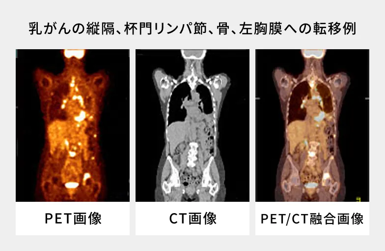 乳がんの縦隔、杯門リンパ節、骨、左胸膜への転移例