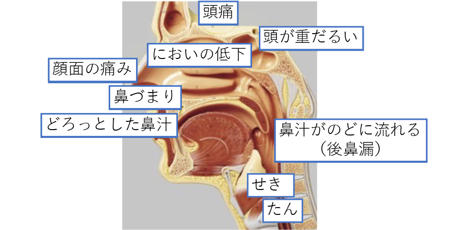 好酸球性副鼻腔炎 みんなの医療ガイド 兵庫医科大学病院