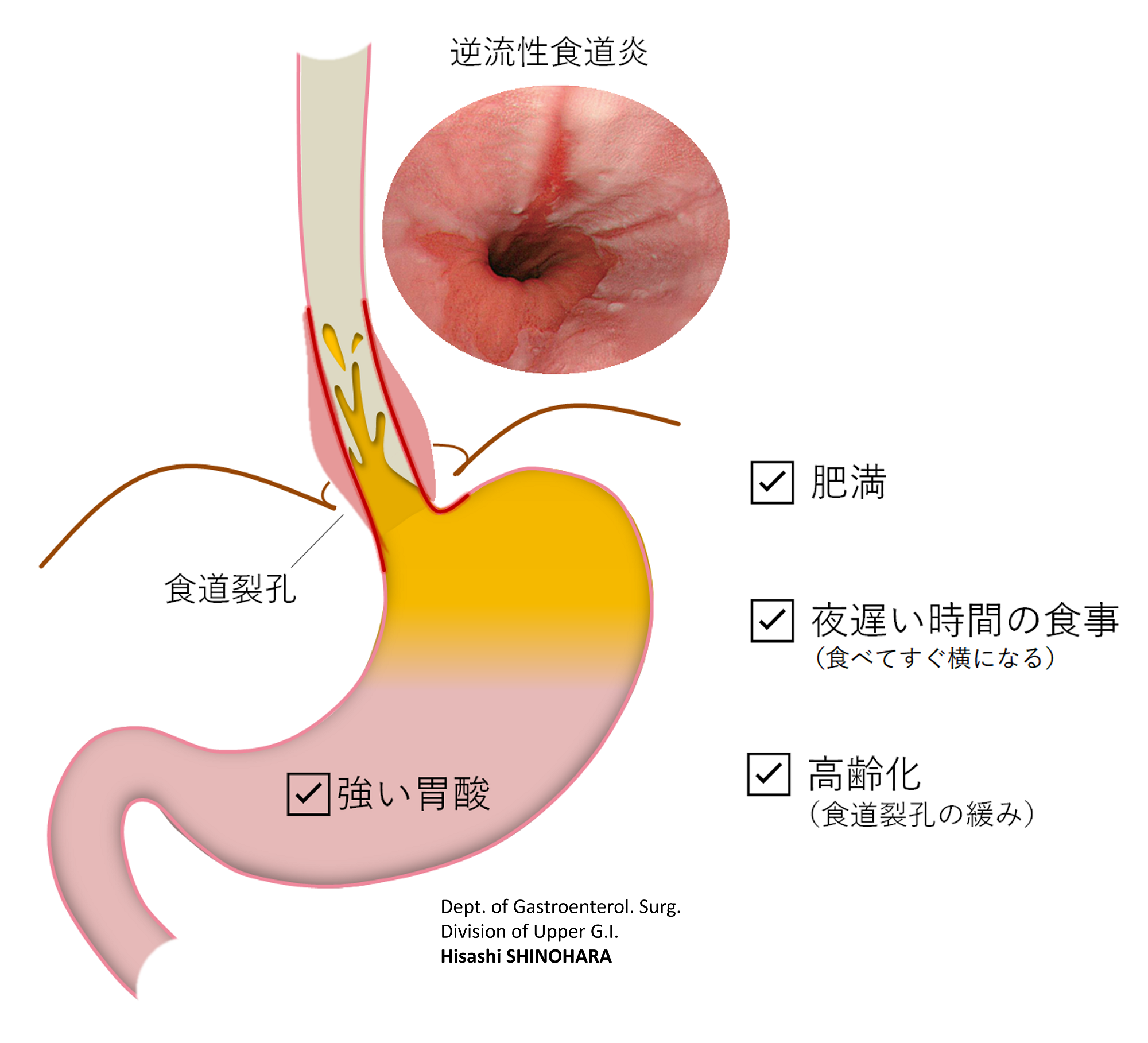 胃 に カビ が 生える 病気