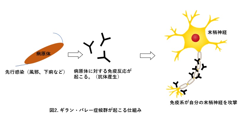 ギラン・バレー症候群の潜在的な合併症