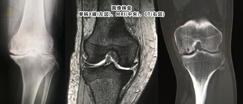 変形性膝関節症 | みんなの医療ガイド | 兵庫医科大学病院 変形性膝関節症 | みんなの医療ガイド | 兵庫医科大学病院