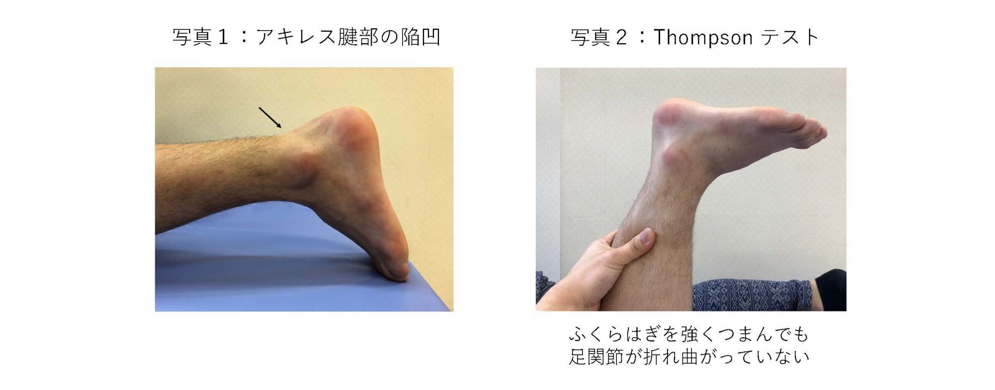 アキレス腱断裂 みんなの医療ガイド 兵庫医科大学病院