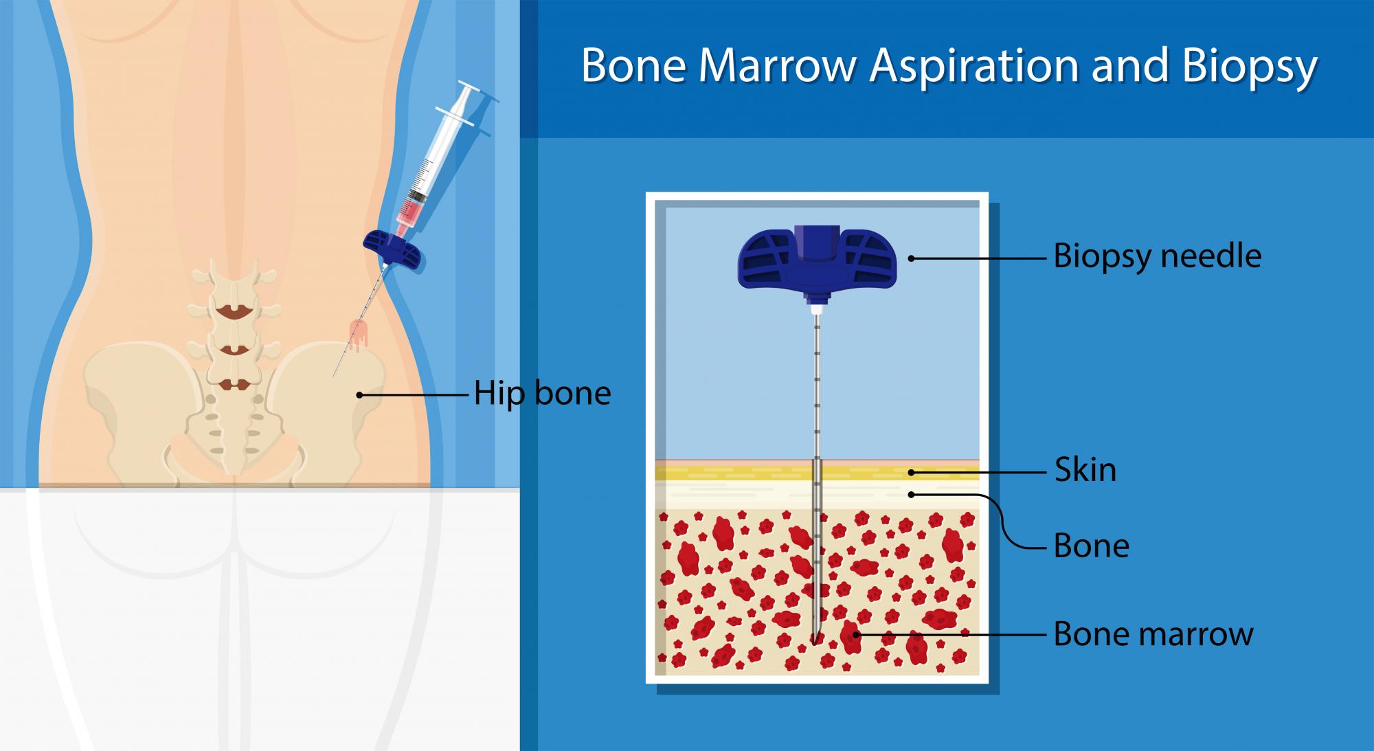 多発性骨髄腫の原因は何ですか?