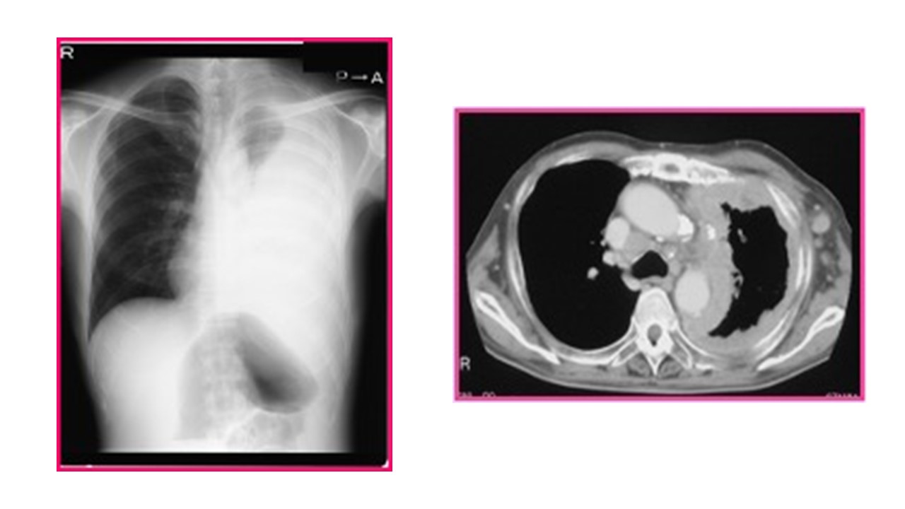 胸膜中皮腫とは何ですか?
