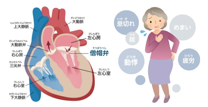 僧帽弁逸脱はどのように診断されますか?