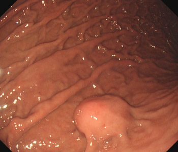 下 腫瘍 粘膜 胃粘膜下腫瘍（ＳＭＴ）の治療方針