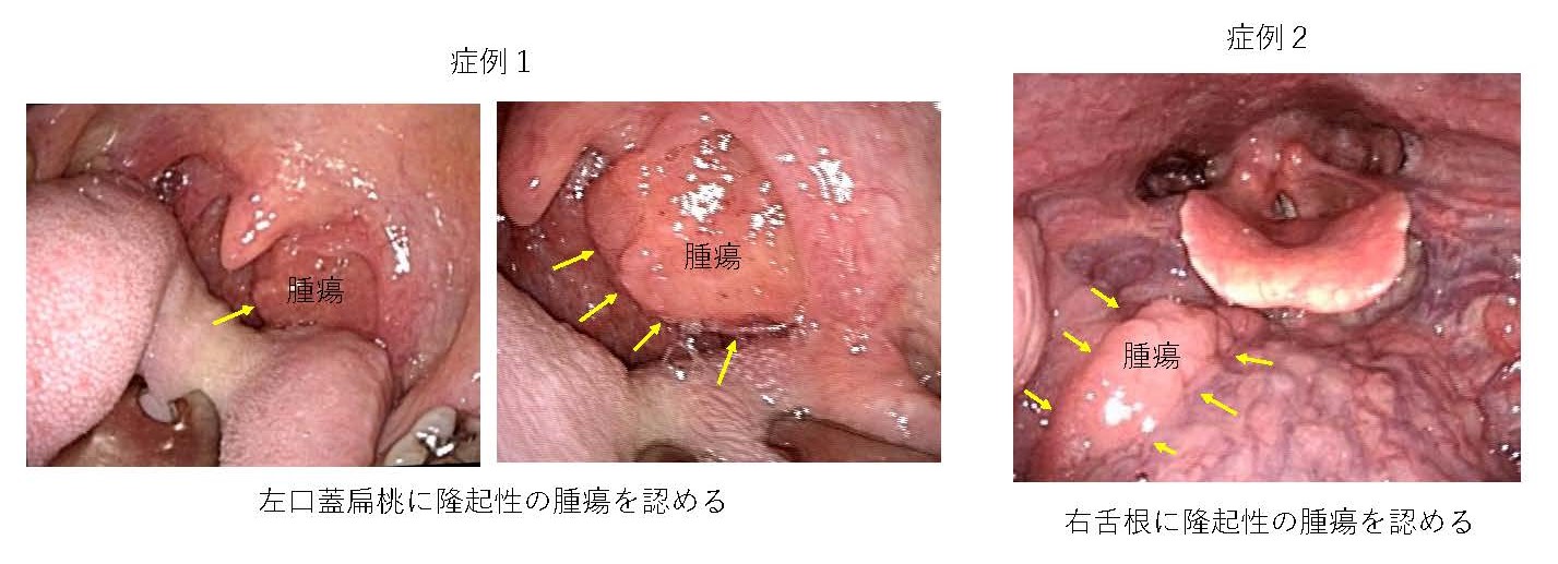 中咽頭がん みんなの医療ガイド 兵庫医科大学病院