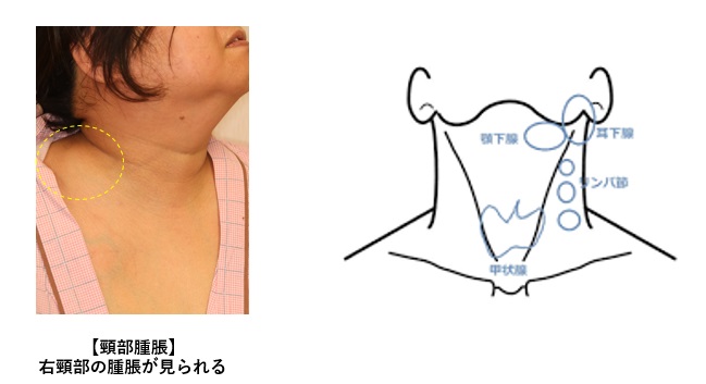 リンパ節とは何ですか?