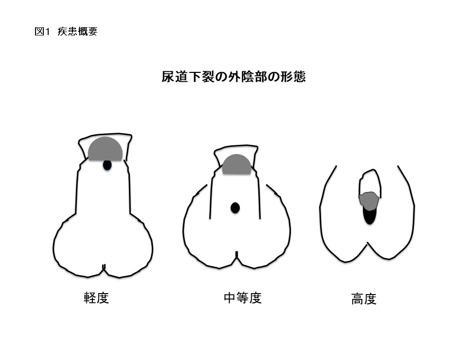 尿道下裂 | みんなの医療ガイド | 兵庫医科大学病院