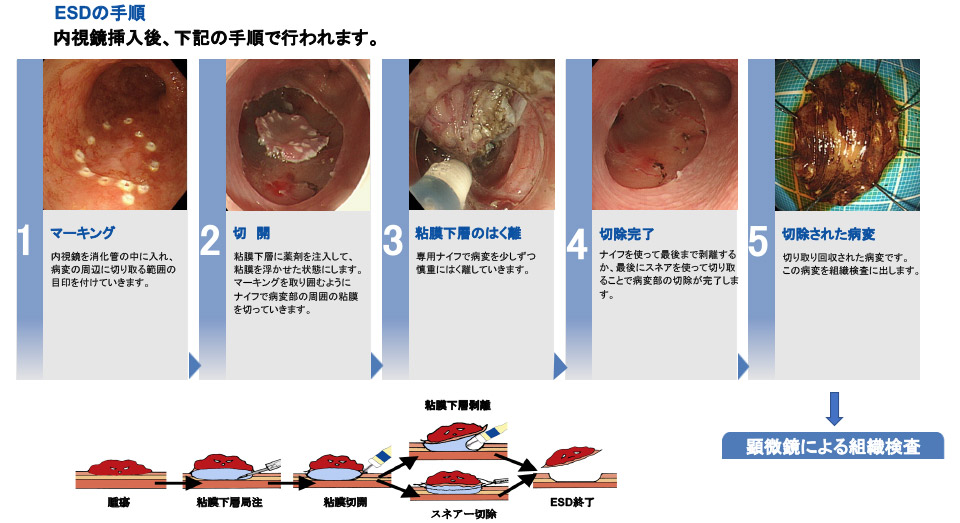 早期食道がん・早期胃がん（内視鏡治療） | みんなの医療ガイド