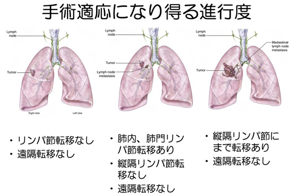 肺がんに最適な食事