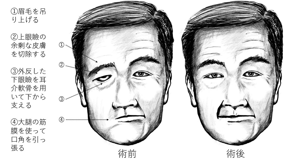 ベル麻痺はどれくらいの期間、目に影響を及ぼしますか?