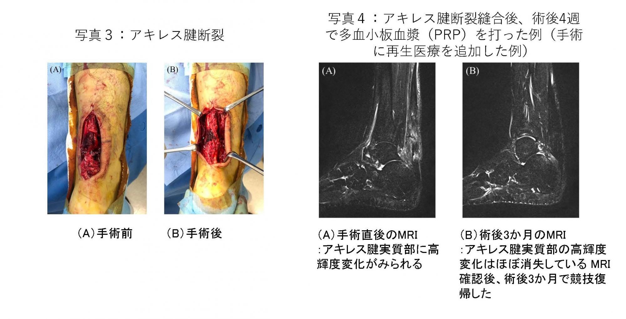 アキレス腱断裂 みんなの医療ガイド 兵庫医科大学病院