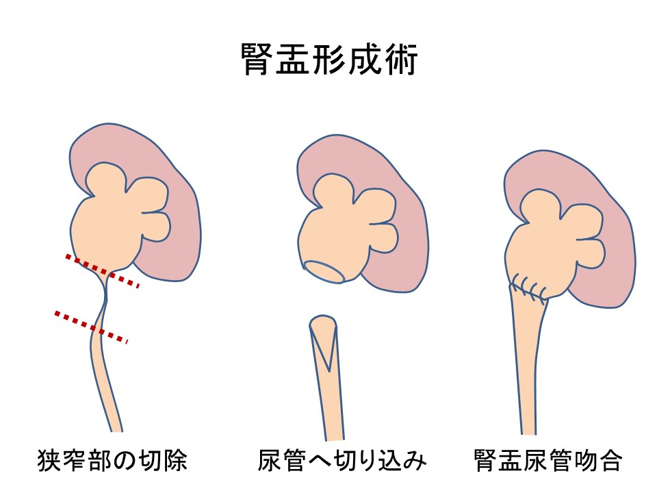 腎盂尿管移行部狭窄 みんなの医療ガイド 兵庫医科大学病院