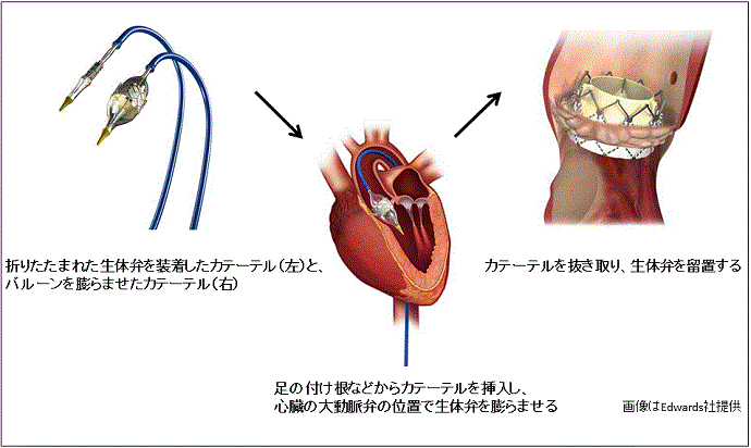 TAVI HP用画像 改3.gif